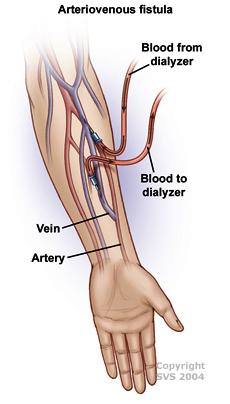 A vein and artery are shown. Blood from dialyzer and blood to dialyzer are depicted.